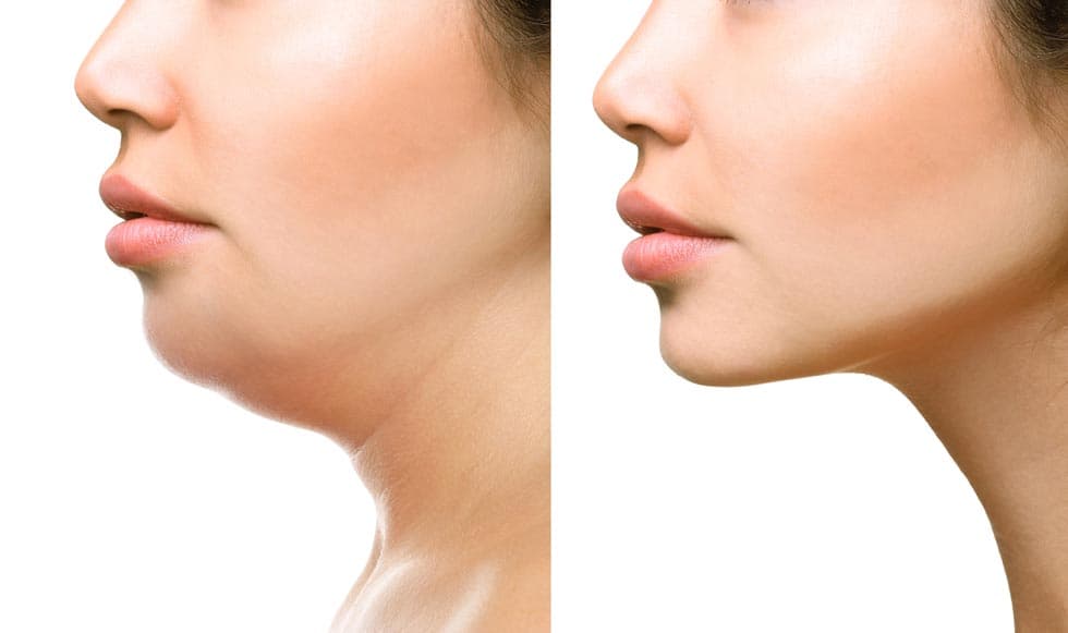 Woman pinching excess fat under her chin