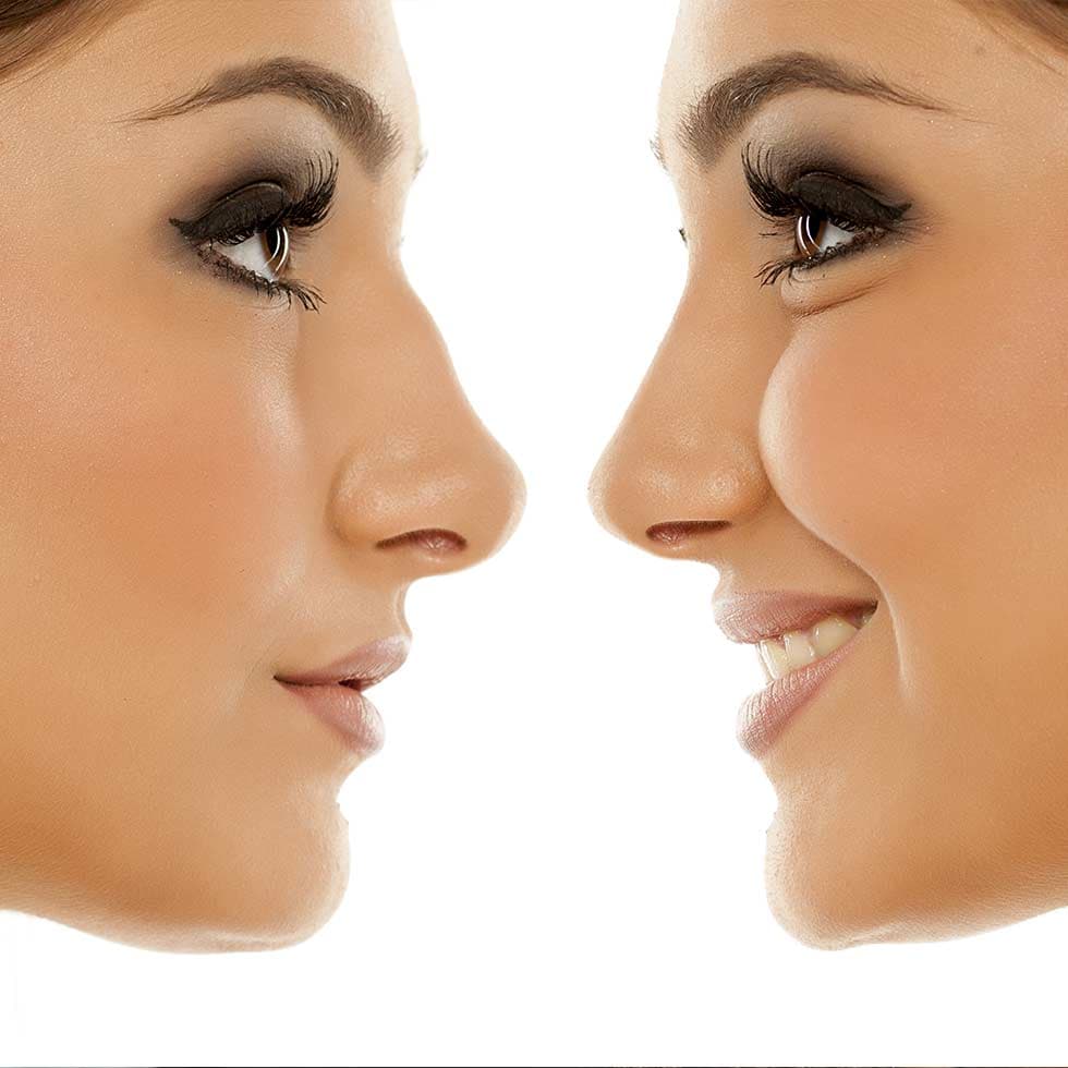 Woman receiving a non-surgical rhinoplasty filler treatment