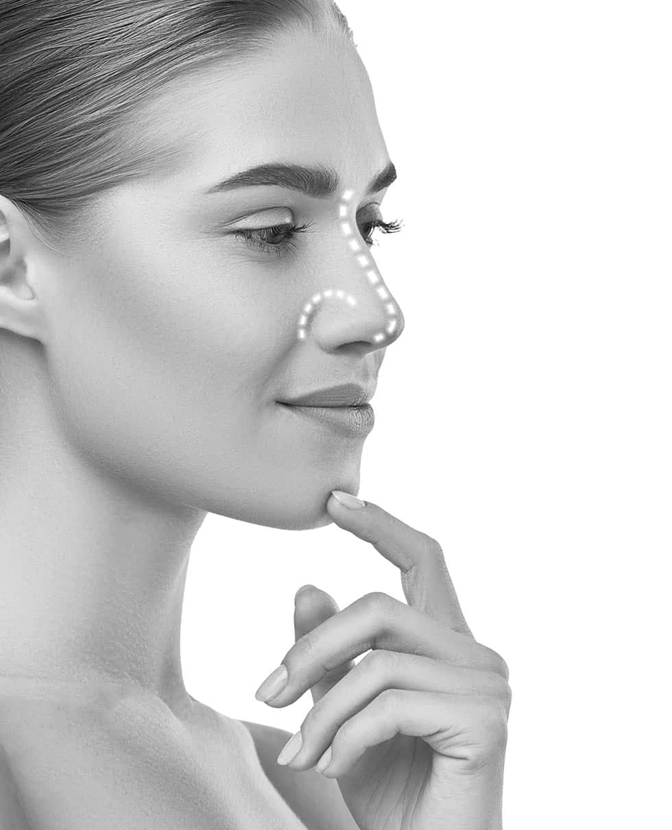 Rhinoplasty