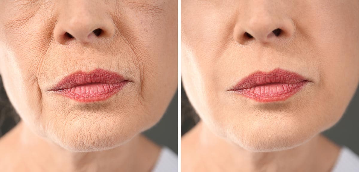 Anti-aging Fractora treatment