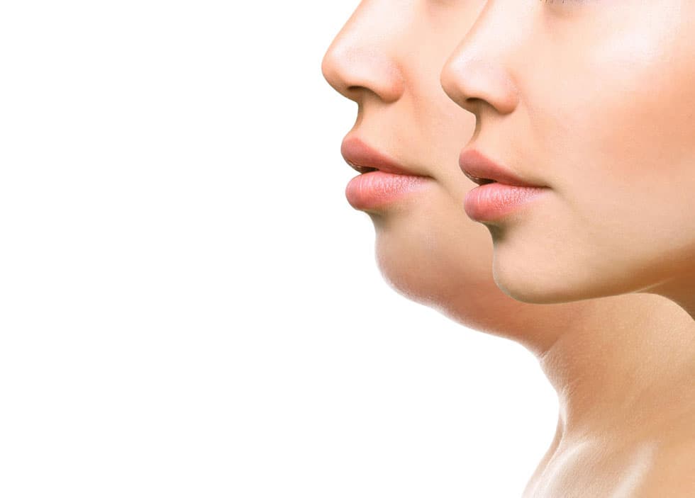 Profile showing a contoured jawline after submental liposuction